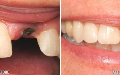 How Much Do Dental Implants Cost in Leesburg? A Comprehensive Guide