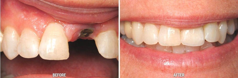 How Much Do Dental Implants Cost in Leesburg? A Comprehensive Guide