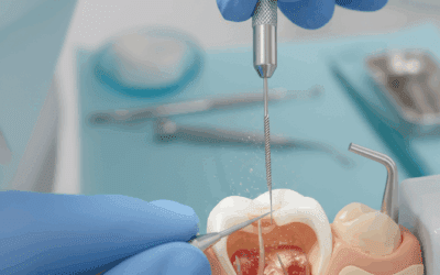 What is a Root Canal? A Pain-Free Guide from Your Leesburg Dentist