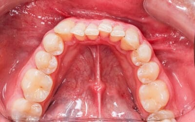 Laser Frenectomy vs. Scissors: Why We Use Lasers for Tongue Ties