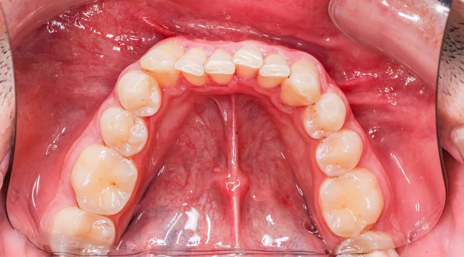 Open mouth with crooked teeth